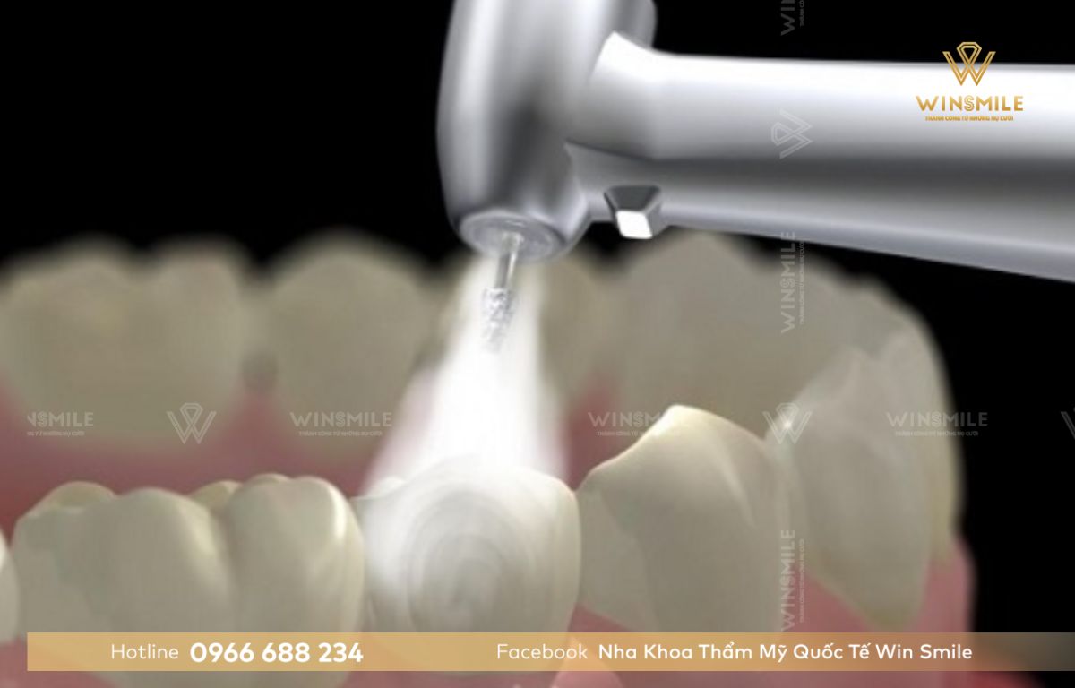 Composite - Vật liệu trám răng thưa phổ biến nhất hiện nay