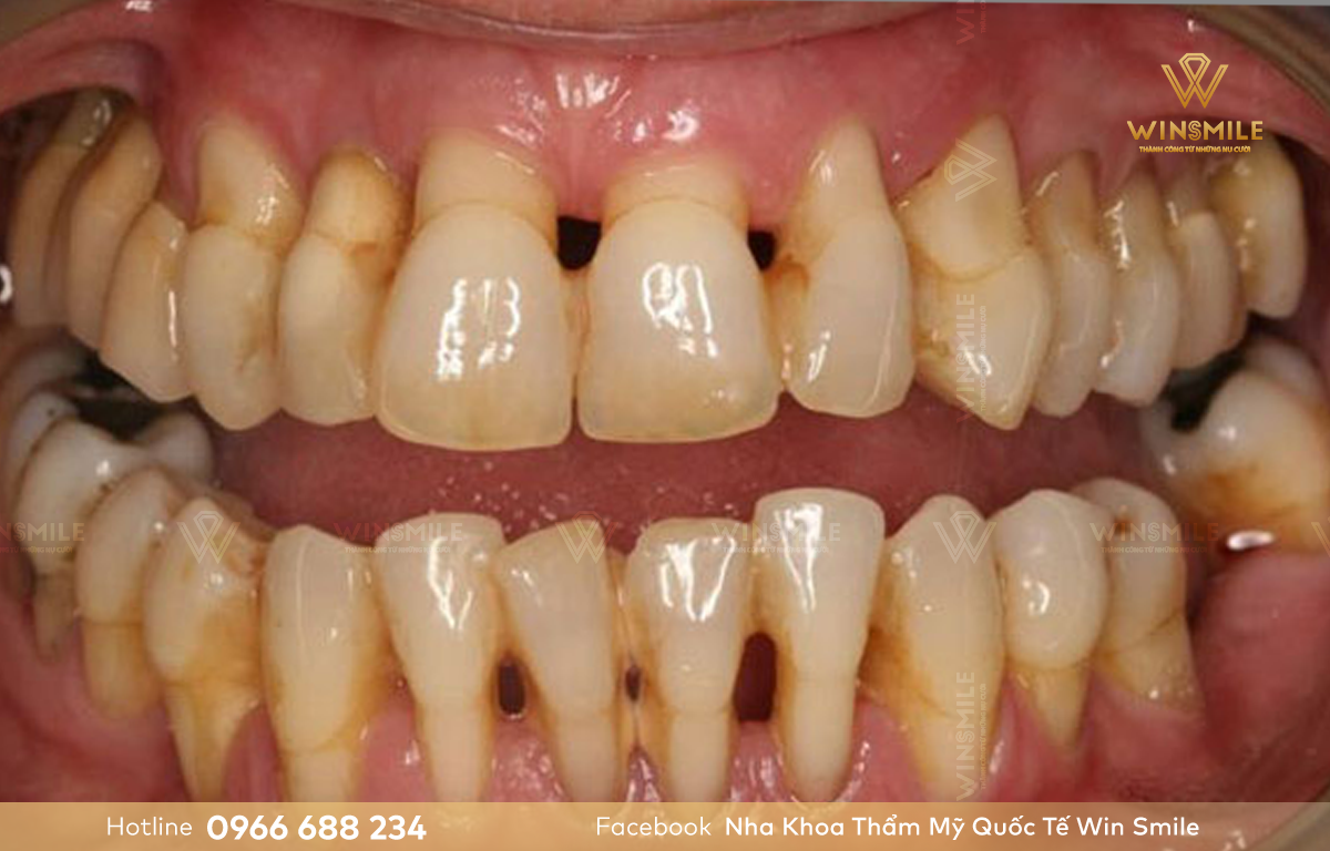 Bệnh lý răng miệng xuất hiện khe thưa giữa các răng