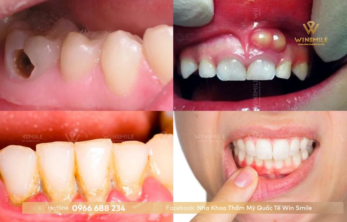 Bệnh lý răng miệng gây răng thưa
