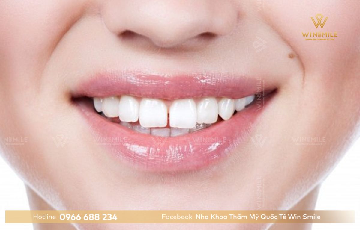 Răng thưa ảnh hưởng đến sức khỏe răng miệng ở phụ nữ