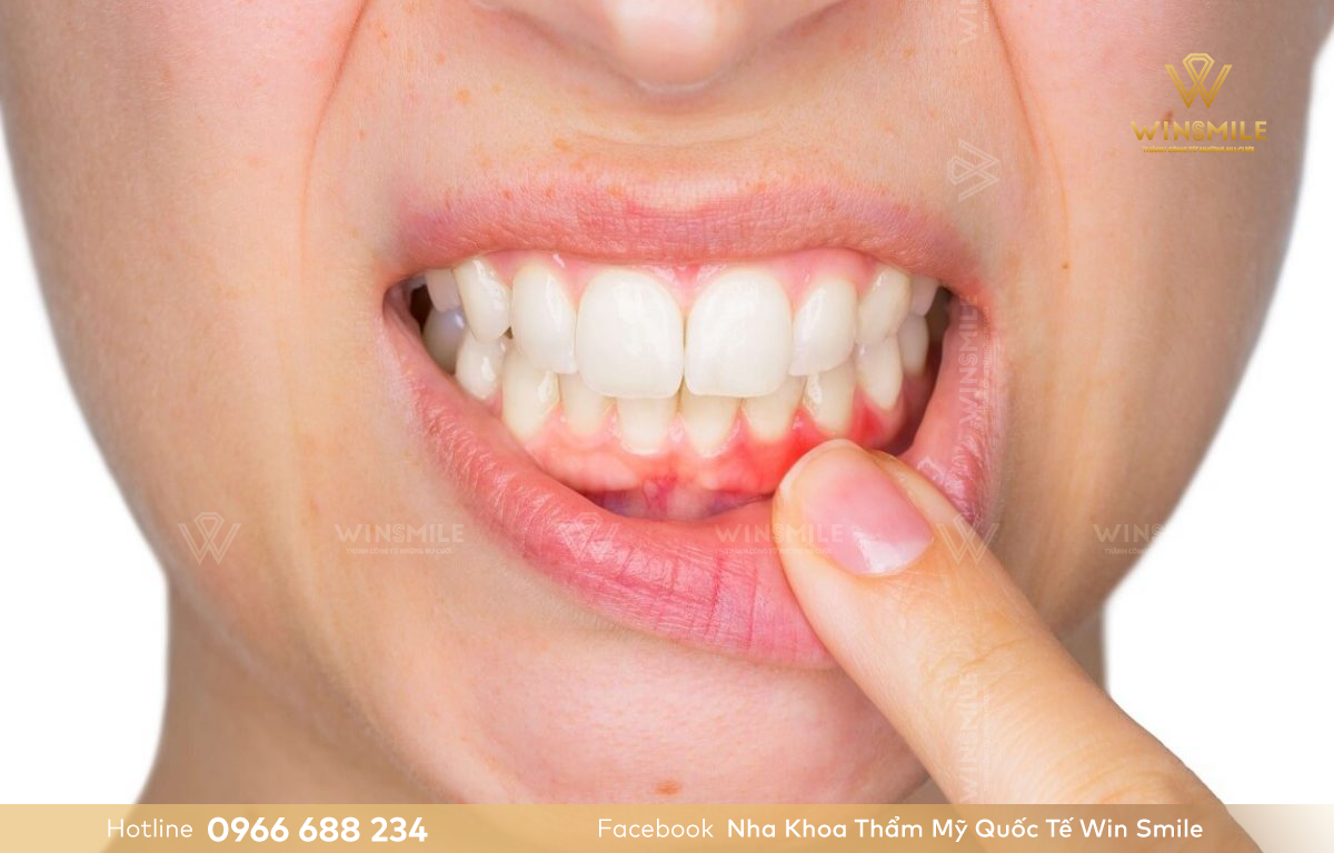 Viêm nha chu là nguyên nhân khiến răng bị thưa dần
