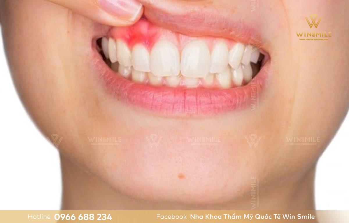 Không tẩy trắng răng khi mắc bệnh lý răng miệng.