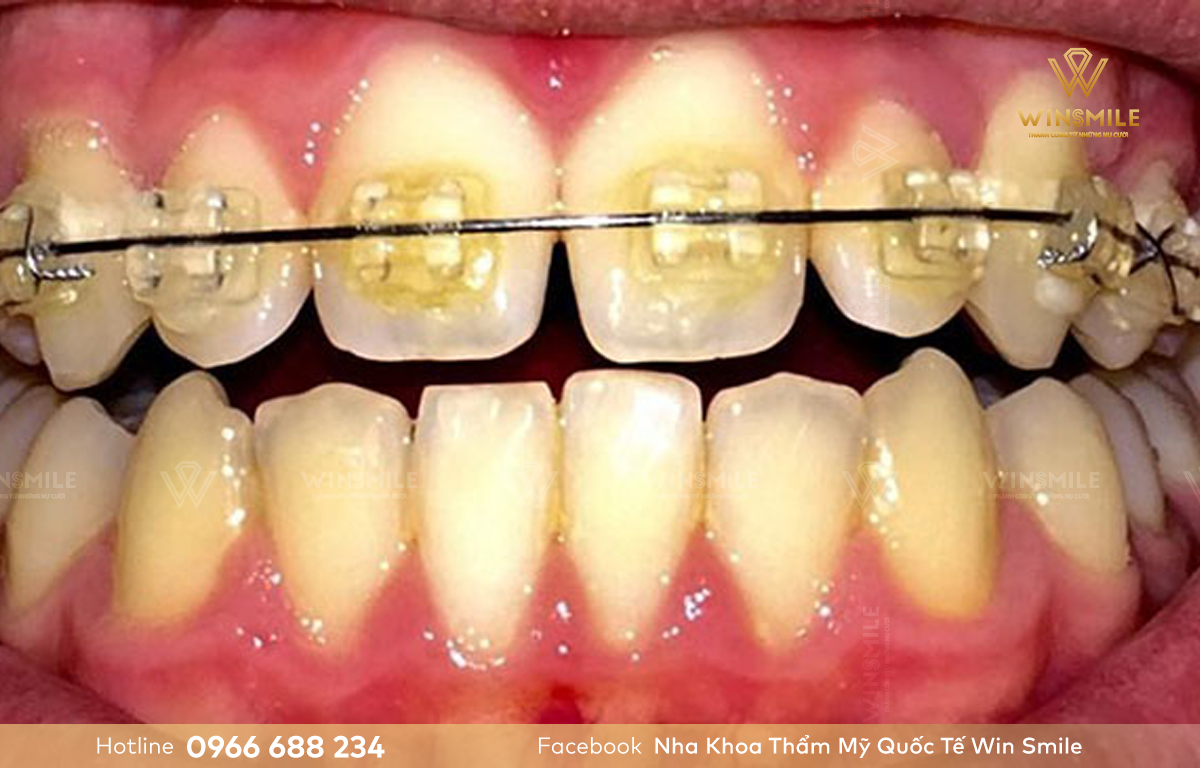 Răng ố vàng sau niềng là hiện tượng thường gặp