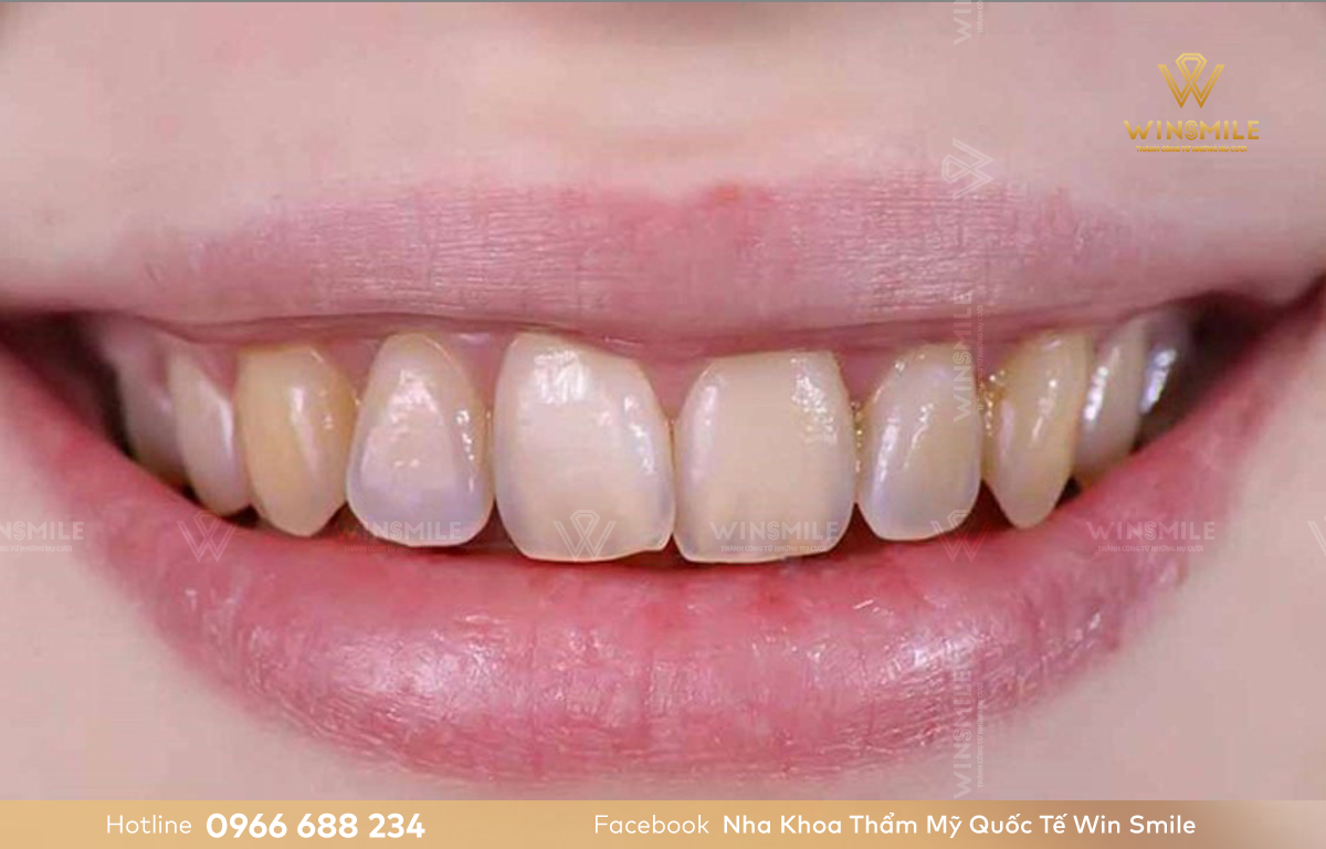 Nền răng yếu là nguyên nhân gây ê buốt sau tẩy trắng răng.