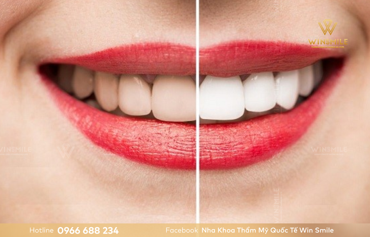 Tẩy trắng răng sau niềng giúp hàm răng trắng sáng tự nhiên