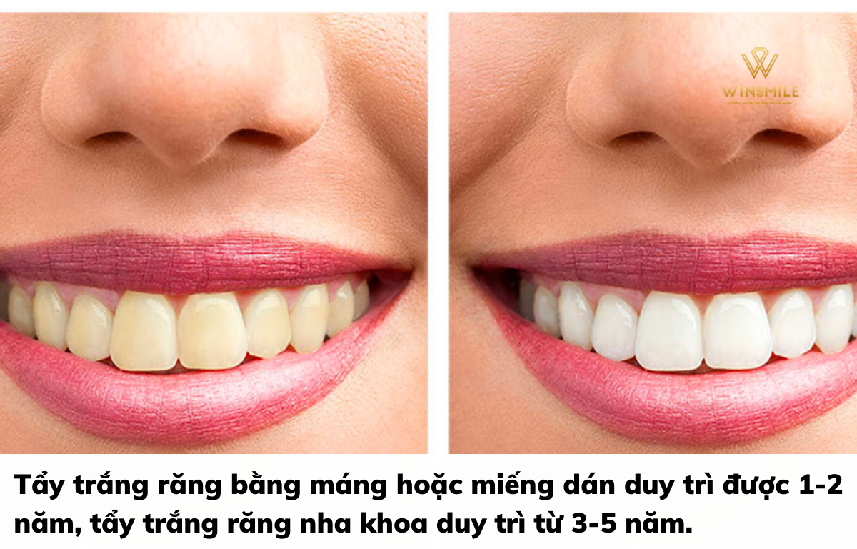 Tẩy trắng răng duy trì được từ 1-5 năm tùy vào mỗi phương pháp 