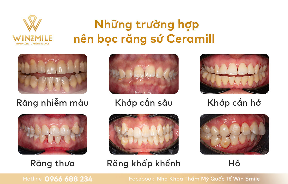 Những trường hợp nào nên bọc răng sứ Ceramill