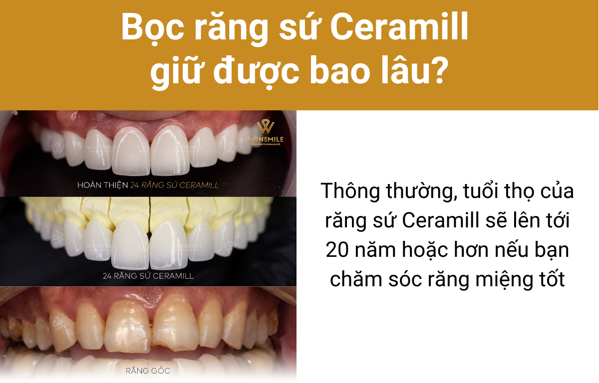 Bọc răng sứ Ceramill giữ được bao lâu?