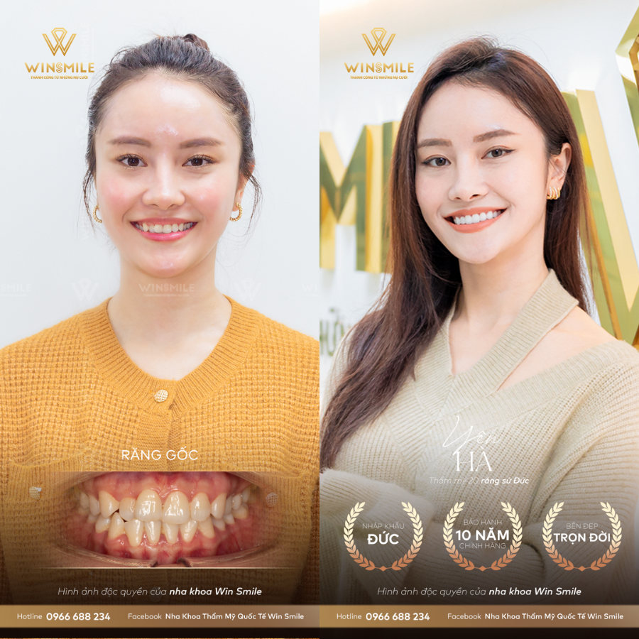 Hình ảnh khách hàng bọc răng sứ tại Win Smile