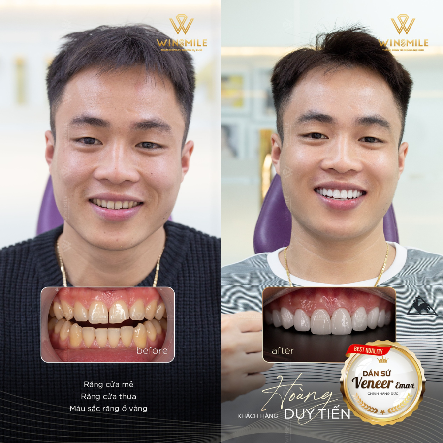 Hình ảnh khách hàng bọc răng sứ tại Win Smile