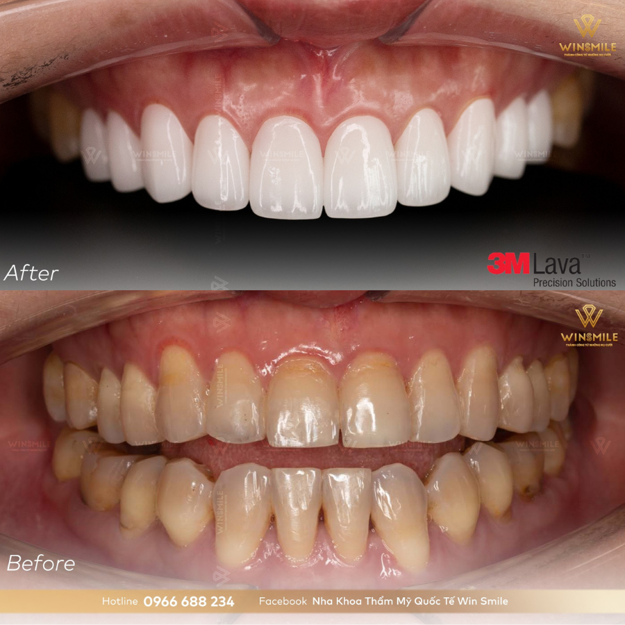 Hình ảnh trước - sau khi bọc răng sứ Lava Plus 3M