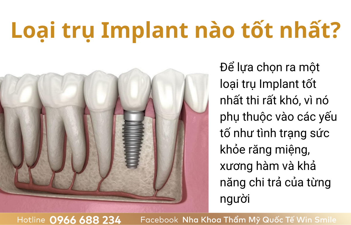 Loại trụ Implant nào tốt nhất?