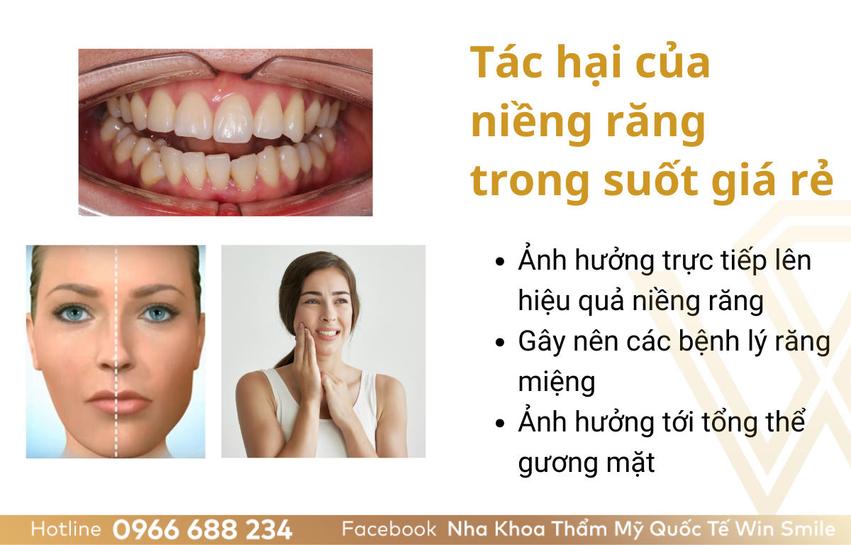Tác hại của việc sử dụng niềng răng trong suốt giá rẻ