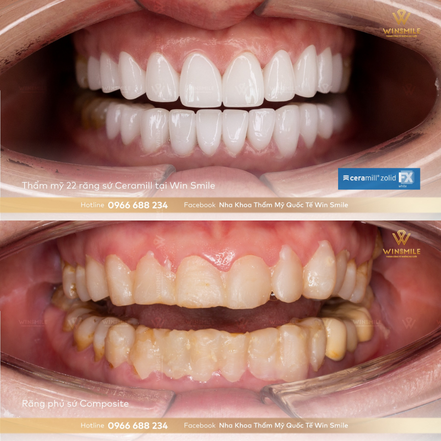 Trường hợp khách hàng bọc răng sứ thành công tại Win Smile