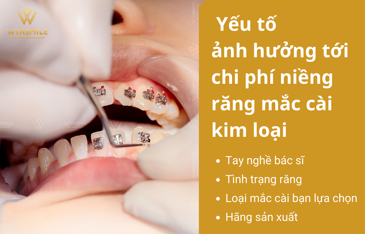 yếu tố ảnh hưởng tới chi phí niềng răng mắc cài kim loại