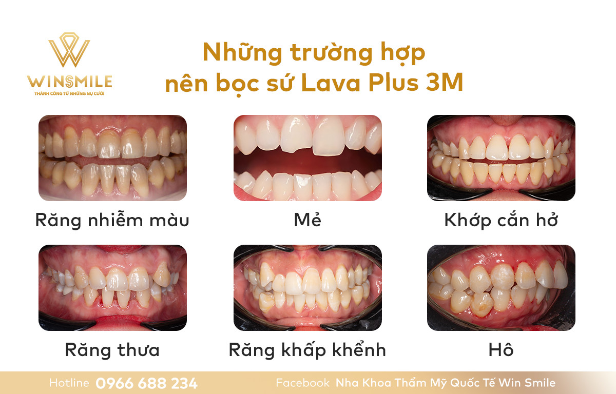 Những trường hợp nào nên bọc răng sứ Lava Plus 3M 