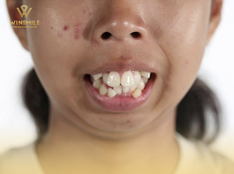 Răng hô vẩu Nguyên nhân là gì Giải pháp nào dành cho răng vẩu