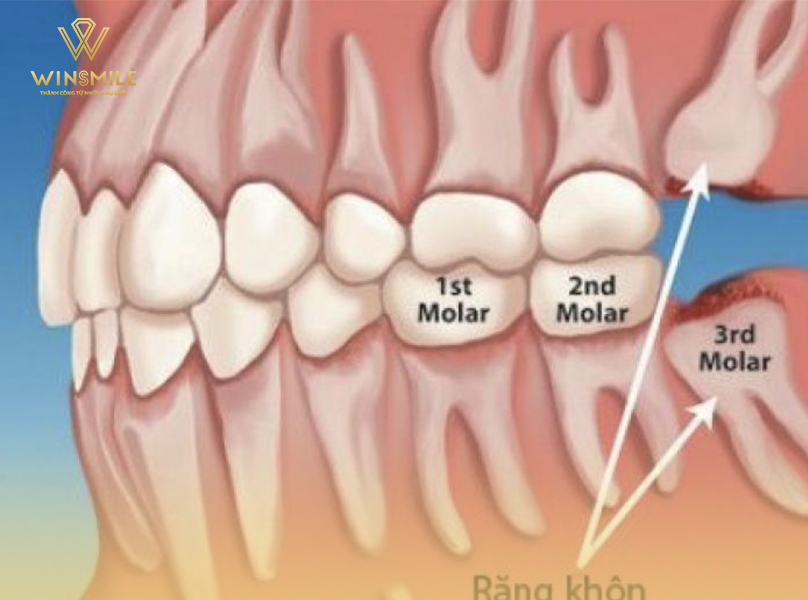 Chi phí nhổ răng số 8 tại các phòng khám uy tín