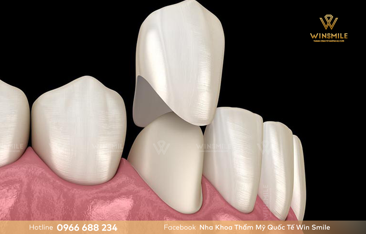 Bọc răng sứ áp dụng có những trường hợp răng hư hỏng nặng