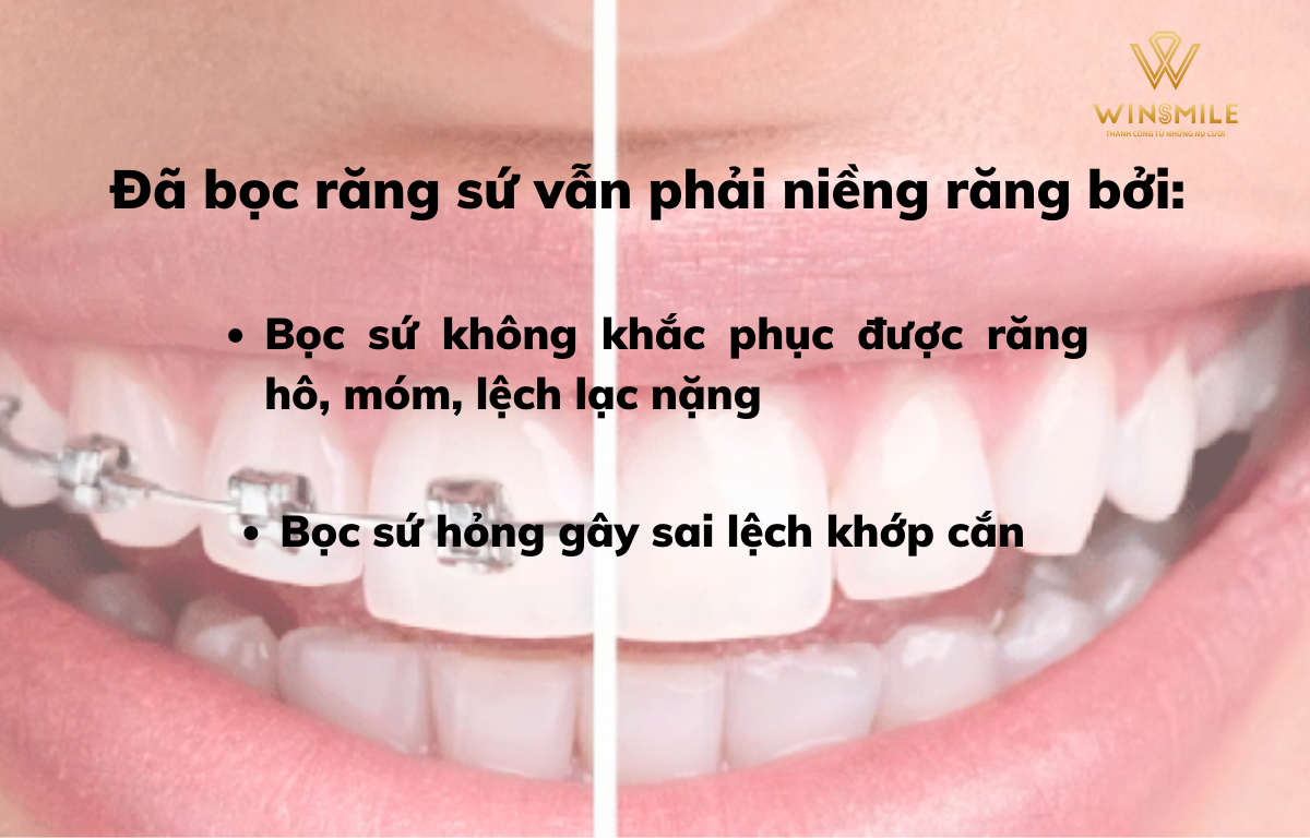 Bọc sứ còn phải niềng răng do nhiều nguyên nhân như bọc sứ hỏng hoặc sai lệch khớp cắn nặng...