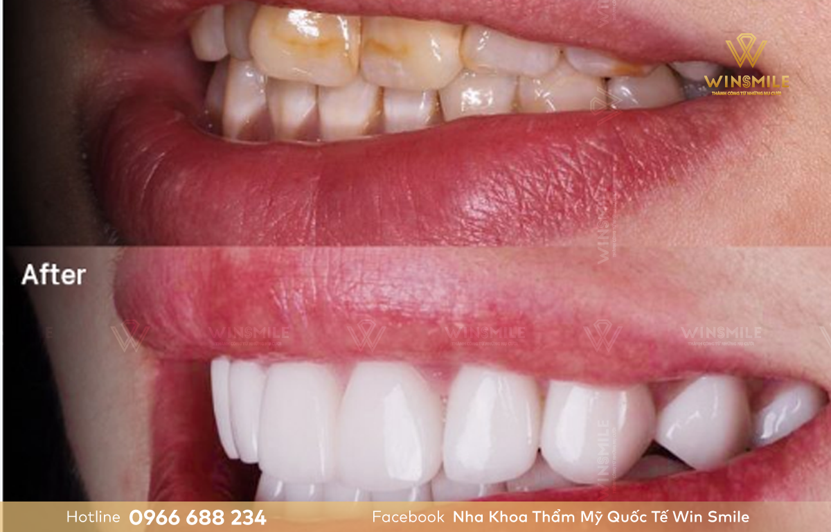 Sứ Ceramill áp dụng cho nhiều trường hợp răng khuyết điểm