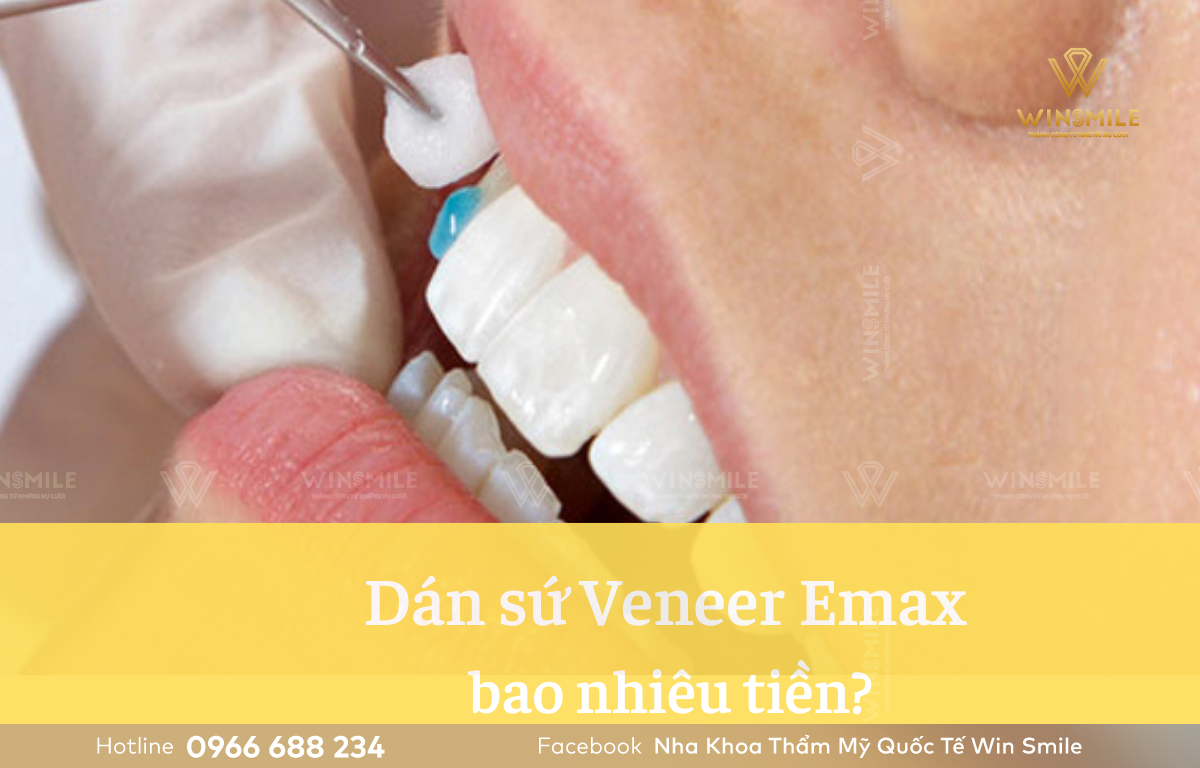 Dán sứ Veneer Emax có giá chênh lệch phụ thuộc vào loại mặt dán và số lượng răng cần dán sứ.