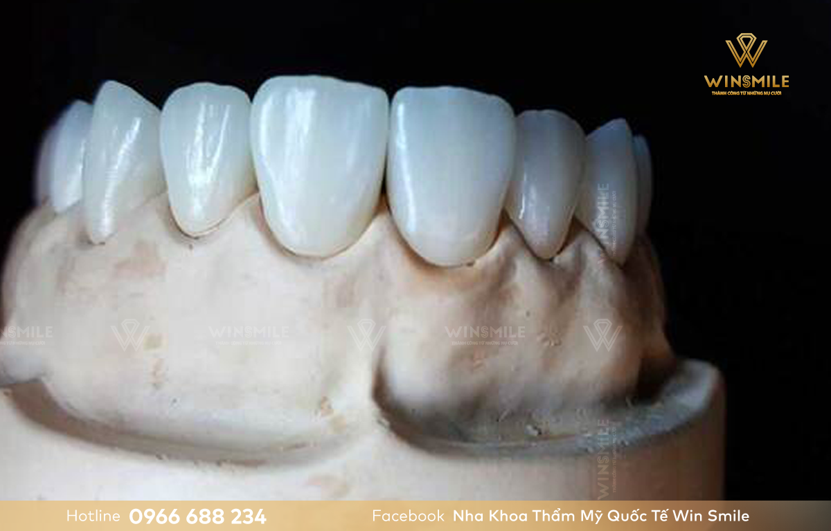 Răng sứ Emax đảm bảo thẩm mỹ tối ưu.