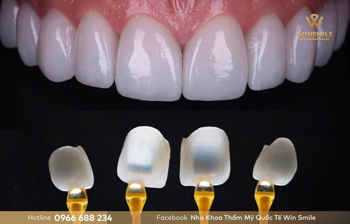 Răng sứ Emax có độ cứng, độ trong hoàn hảo