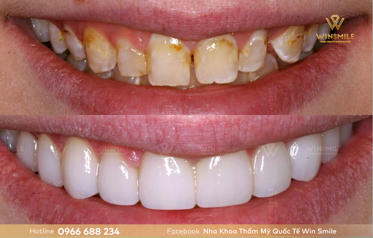 Tình trạng răng miệng quyết định đến chi phí dán sứ veneer bao nhiêu