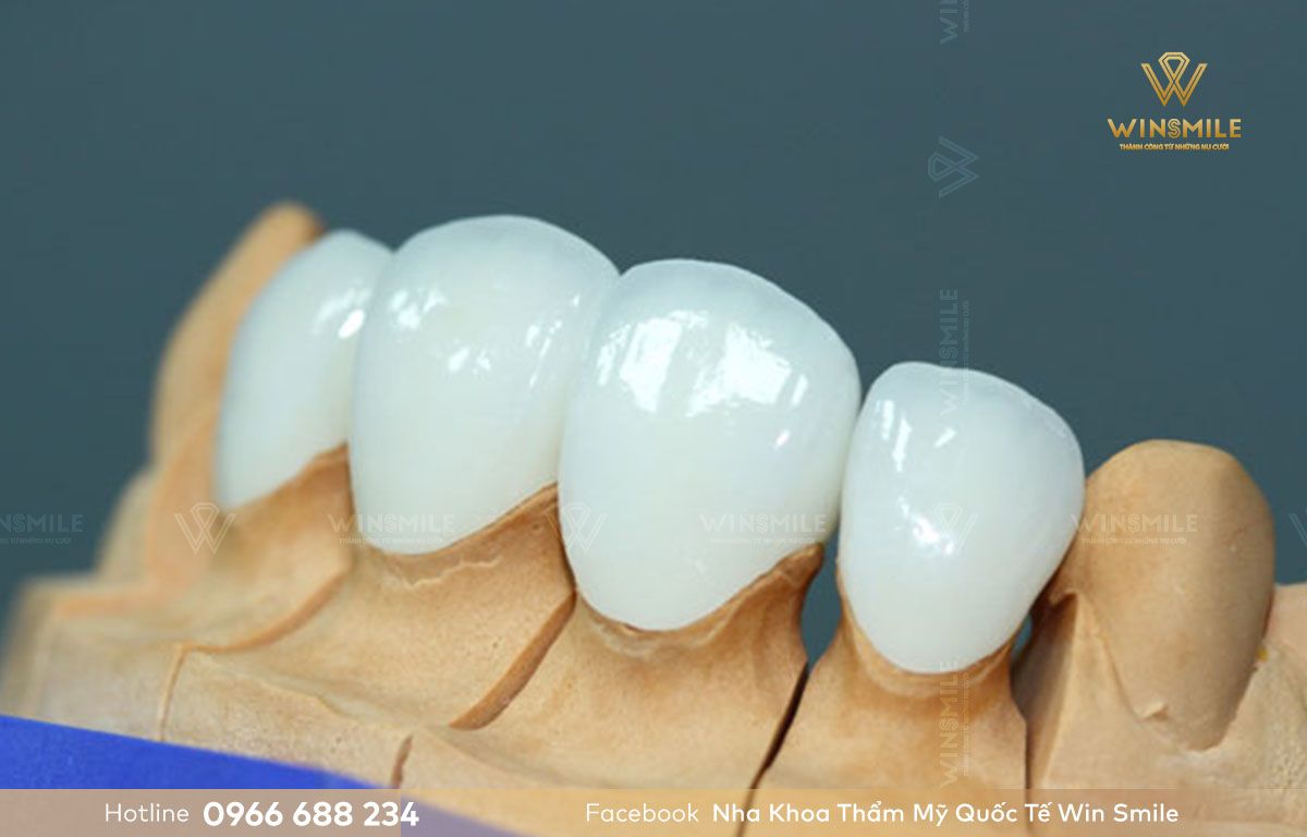 Răng toàn sứ Lava cao cấp đảm bảo tính thẩm mỹ và độ cứng chắc hoàn hảo 