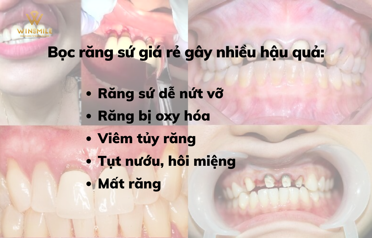 Bọc răng sứ Lava 3M có thể gây nhiều biến chứng nguy hiểm