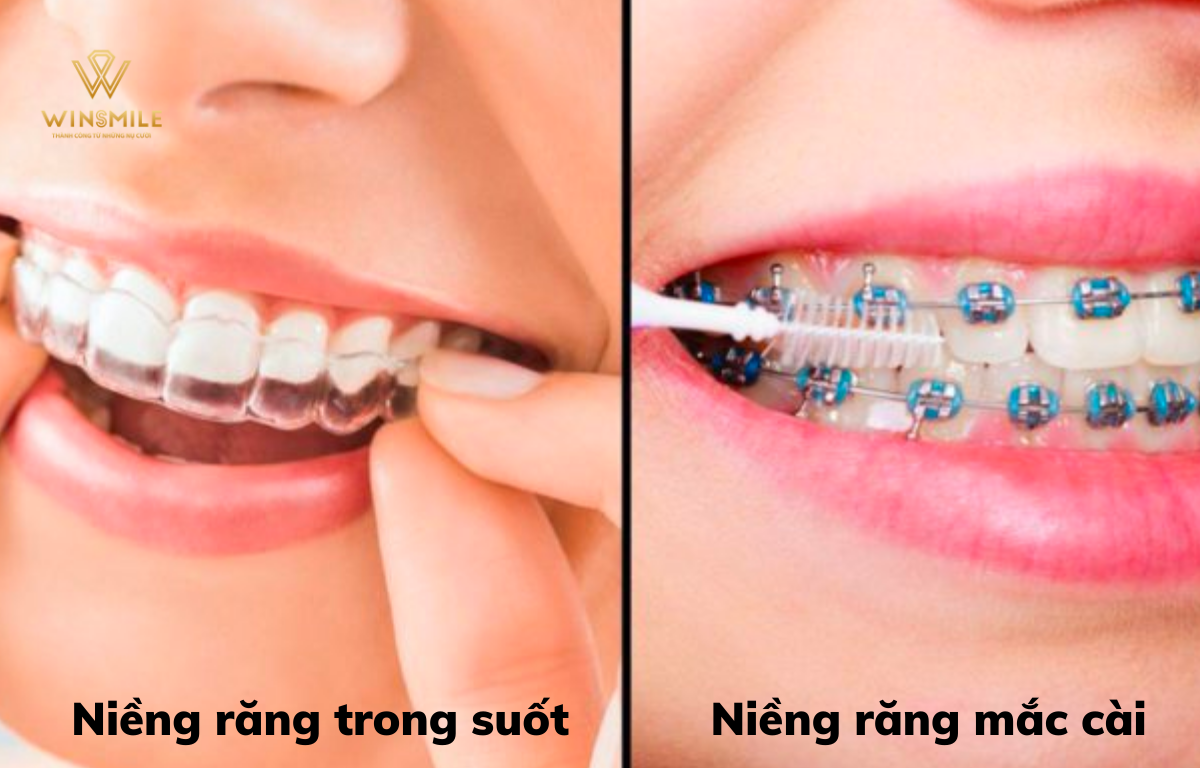Có 2 phương pháp niềng răng được áp dụng phổ biến hiện nay
