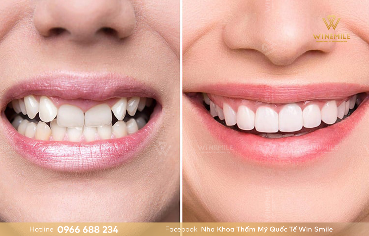Răng bọc sứ áp dụng với nhiều trường hợp, ngay cả răng khấp khểnh nhẹ