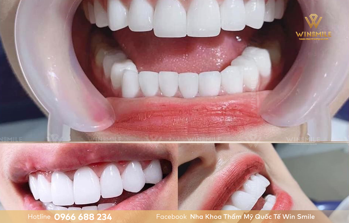 Răng dán sứ Veneer đảm bảo hiệu quả thẩm mỹ cao
