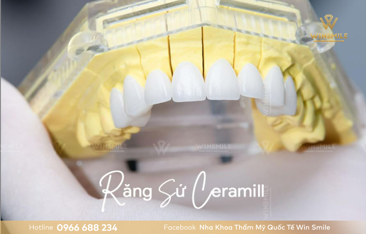 Răng sứ Ceramil đảm bảo chất lượng, nguồn gốc rõ ràng.