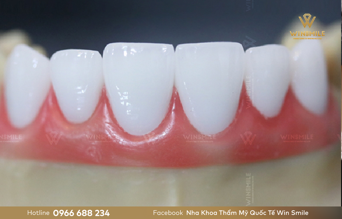 Răng sứ Emax Press là dòng nguyên sứ cho độ cứng cao