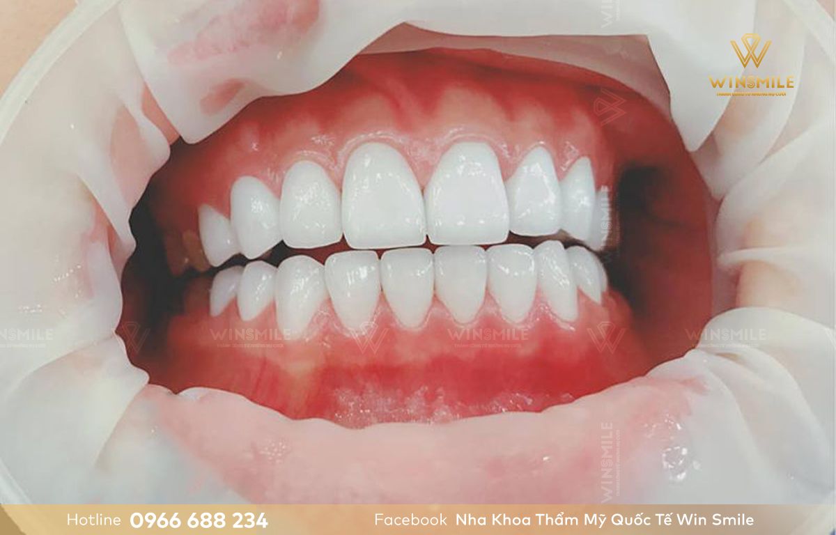 Răng sứ Orodent sản xuất từ bột sứ Zirconia nguyên chất 100%, bóng đẹp và cứng chắc