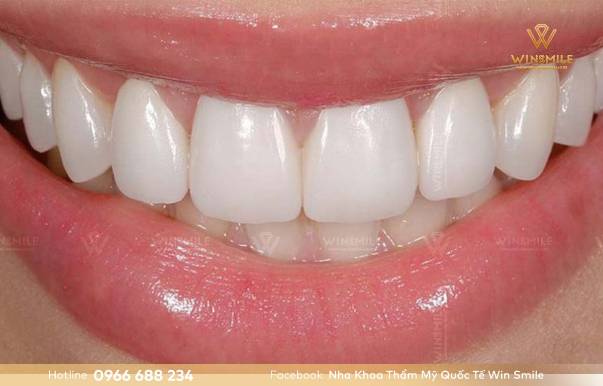 Răng sứ DDBIO là sản phẩm hàng đầu của Đức