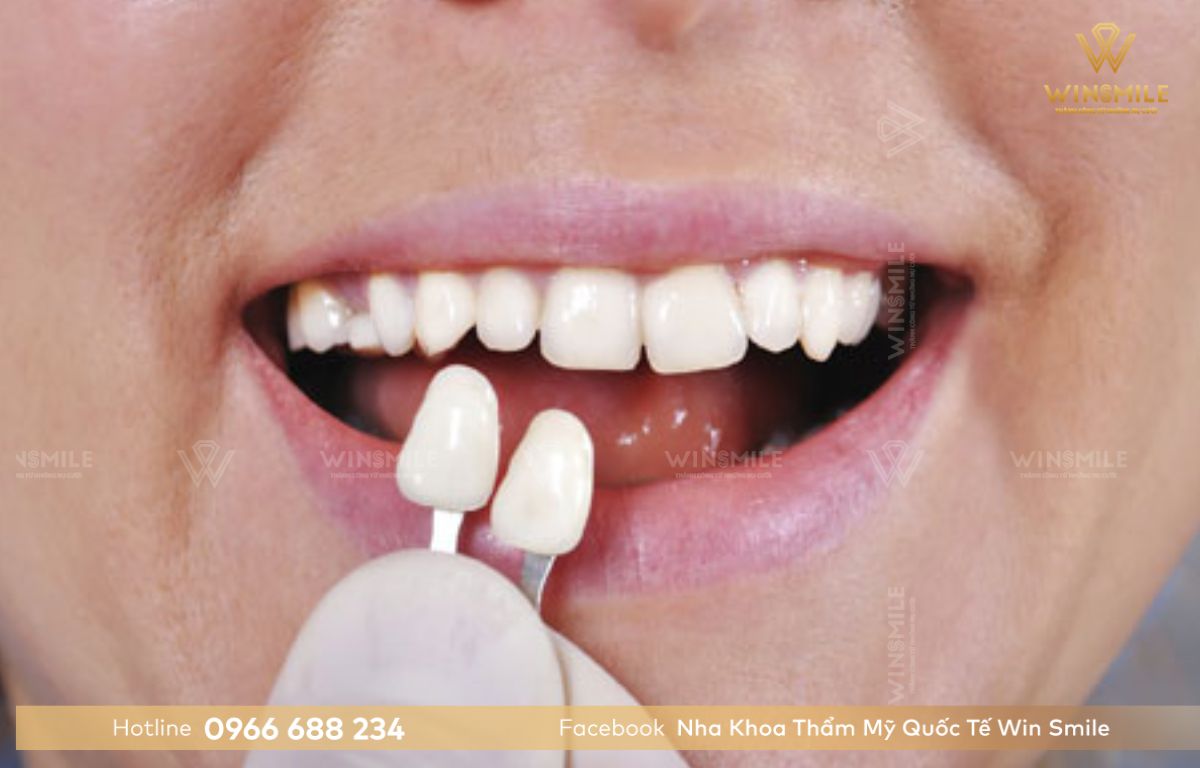 Số lượng răng ảnh hưởng đến chi phí dán sứ veneer