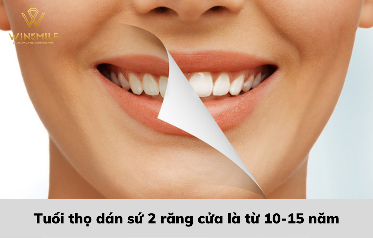 Tuổi thọ răng dán sứ duy trì khoảng 10-15 năm, thậm chí hơn nếu được chăm sóc tốt.