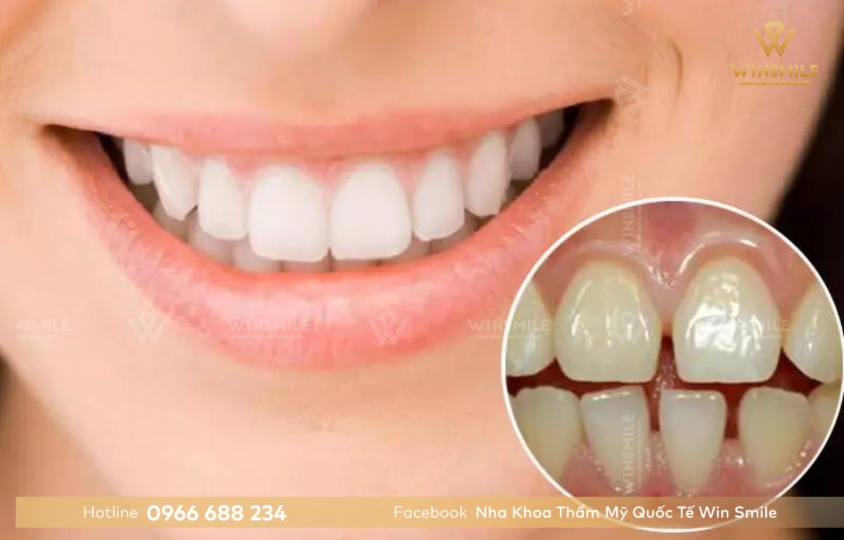 Răng thưa trước và sau khi trám răng