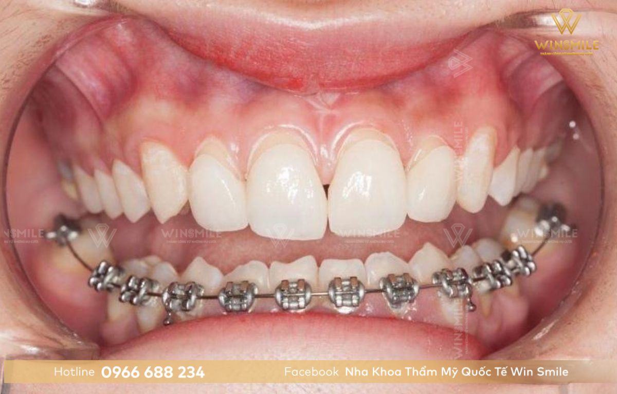 Niềng răng một hàm không mang lại hiệu quả
