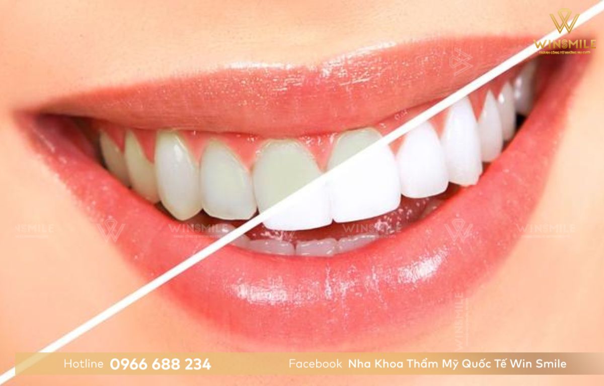 Răng trước và sau khi tẩy trắng