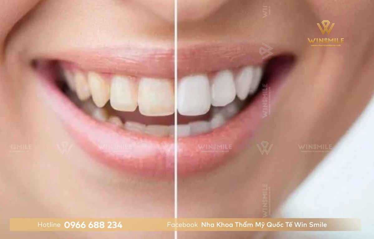 Tẩy trắng răng Plasma mang lại hiệu quả lâu bền