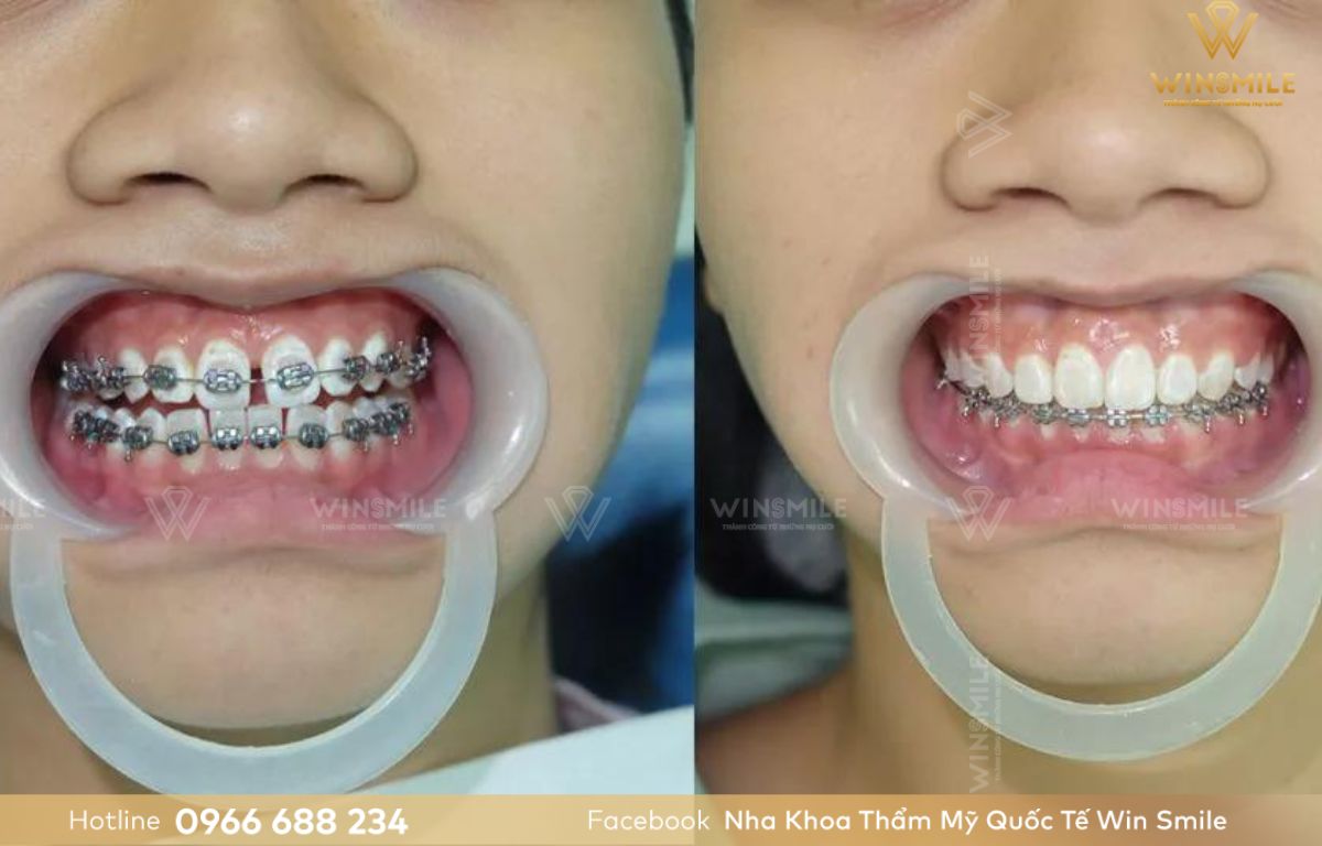 Trước và sau khi niềng răng thưa