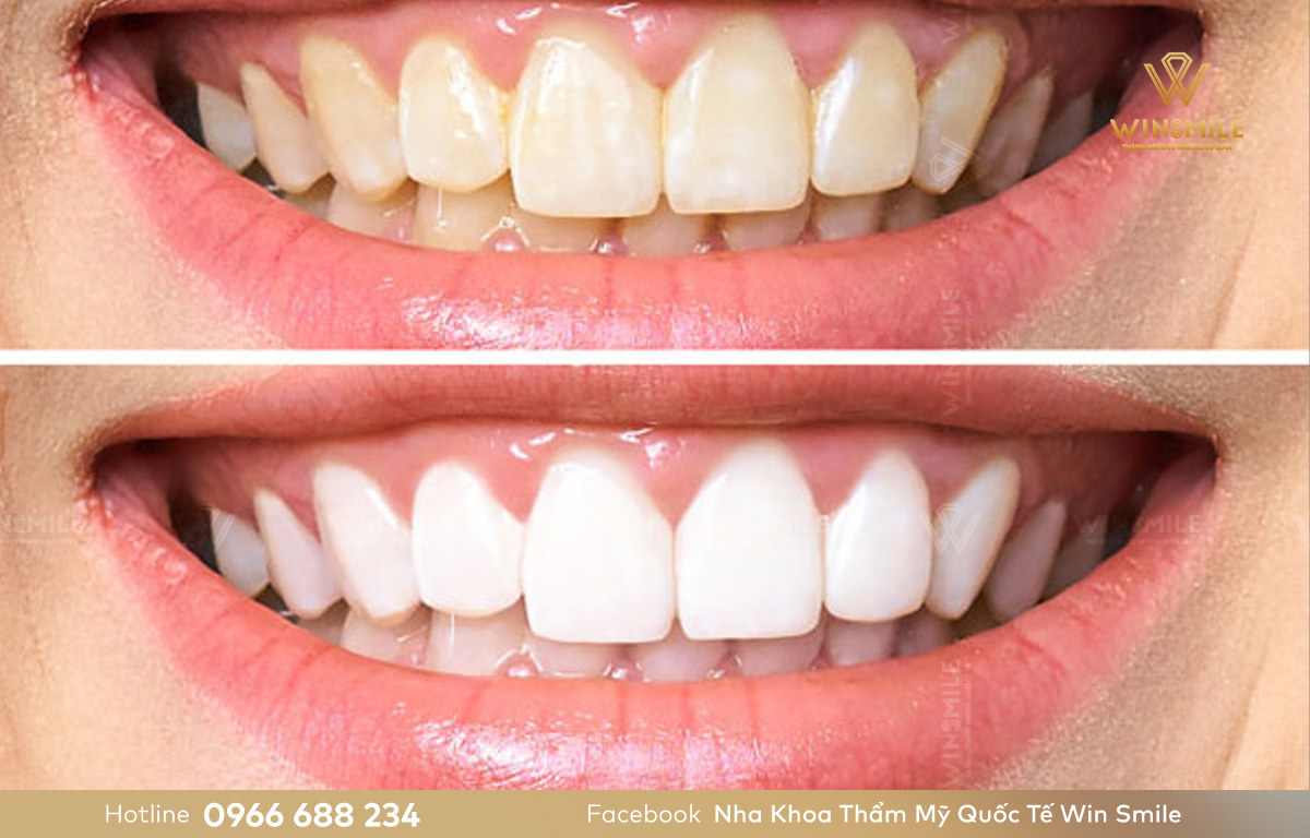 Tẩy trắng răng cho hiệu quả cao, không ảnh hưởng men răng.