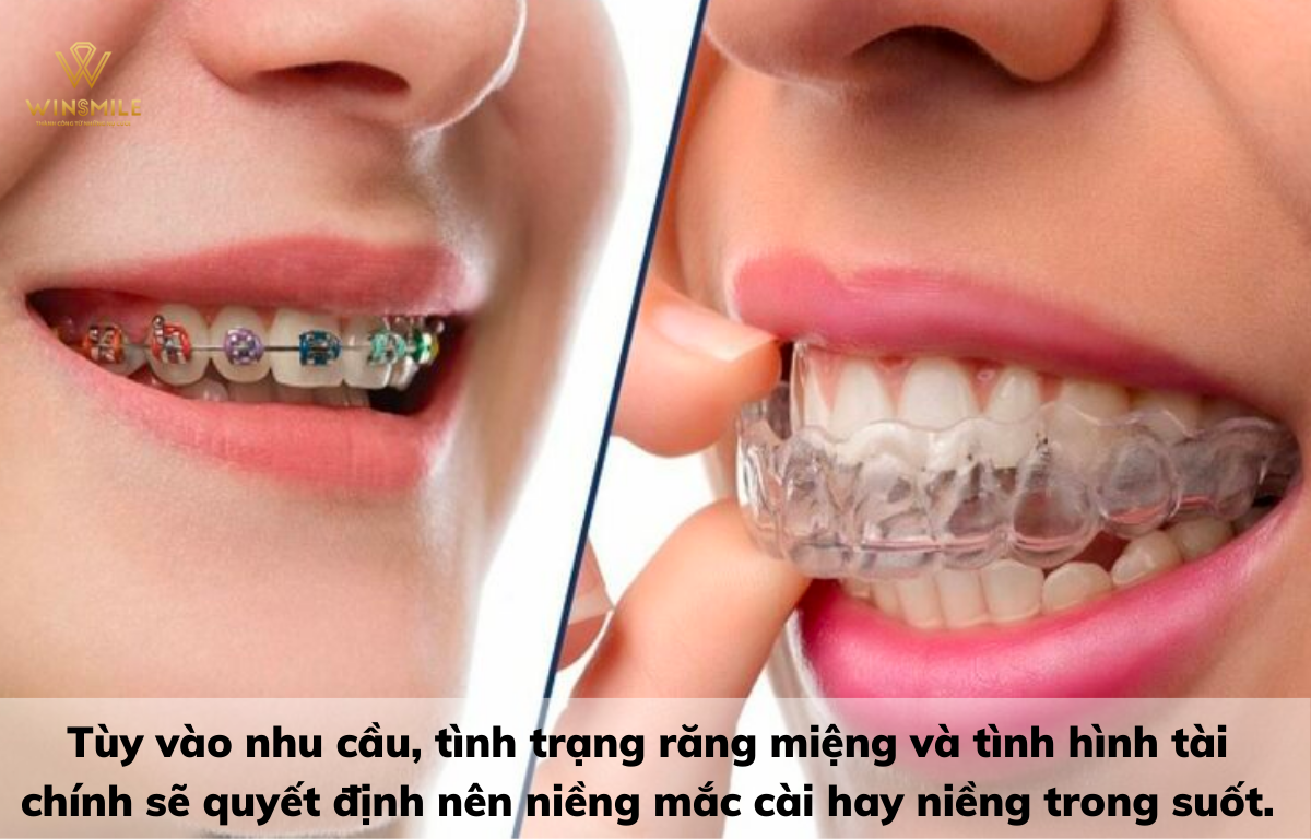 Tùy vào nhu cầu và tình trạng răng miệng sẽ lựa chọn niềng răng mắc cài hay kim loại