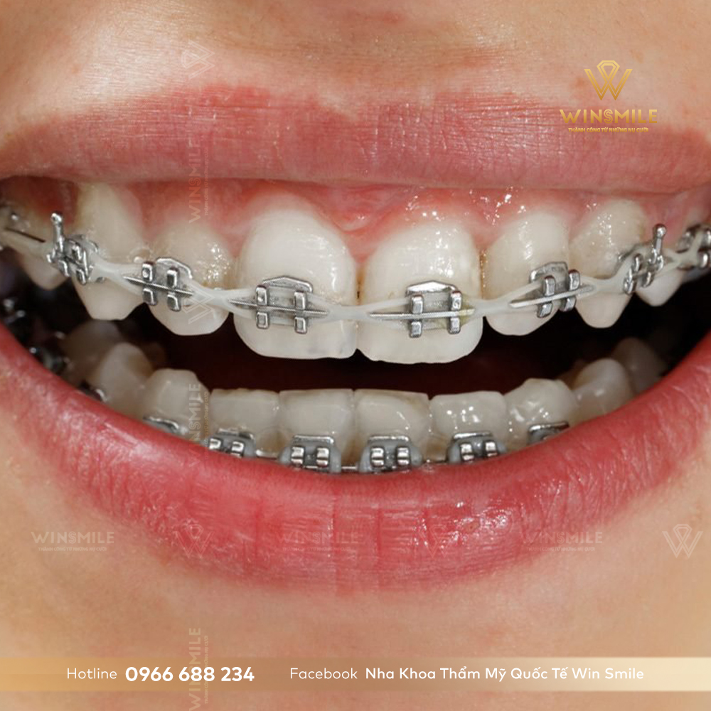 Niềng răng mắc cài buộc chun có hiệu quả như thế nào trong việc chỉnh hình răng và cắn?

