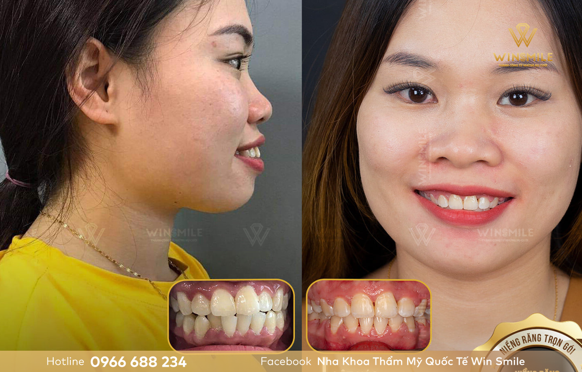 Hình ảnh niềng răng mắc cài tự động của khách hàng tại nha khoa Win Smile