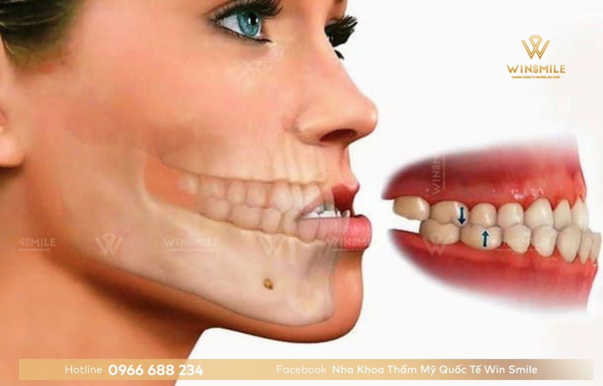 Răng móm ảnh hưởng đến thẩm mỹ và ăn nhai